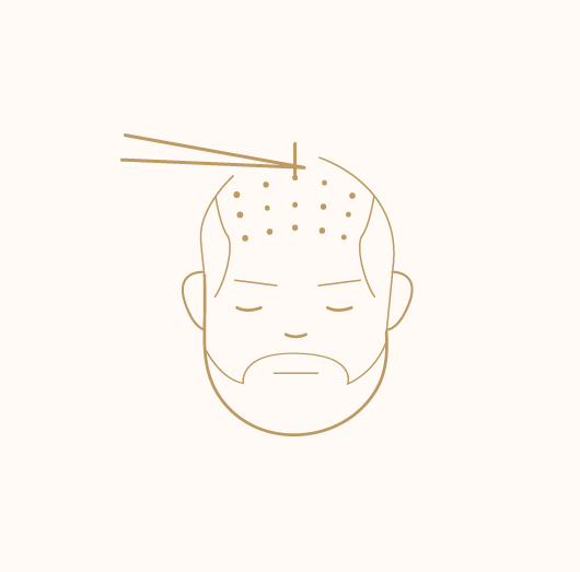 Hair Transplant